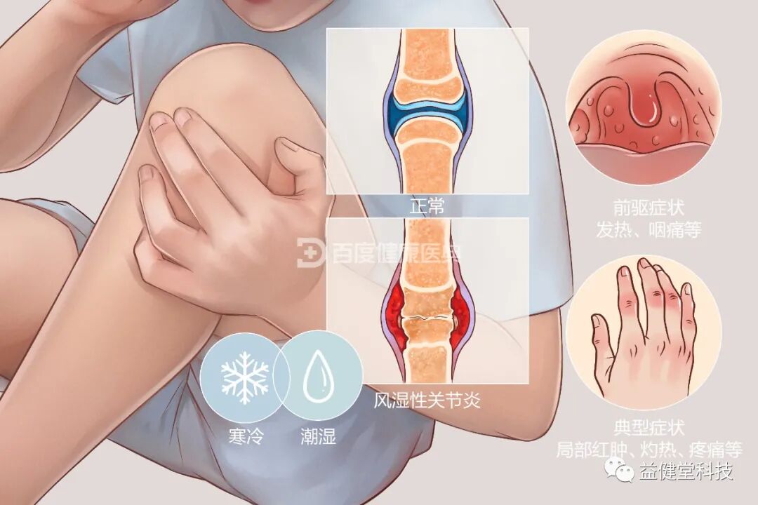 红蓝光治疗仪怎么样【YJT·健康】风湿性关节炎可以用红蓝光治疗仪吗？听专家怎么说_https://www.jmylbn.com_新闻资讯_第1张