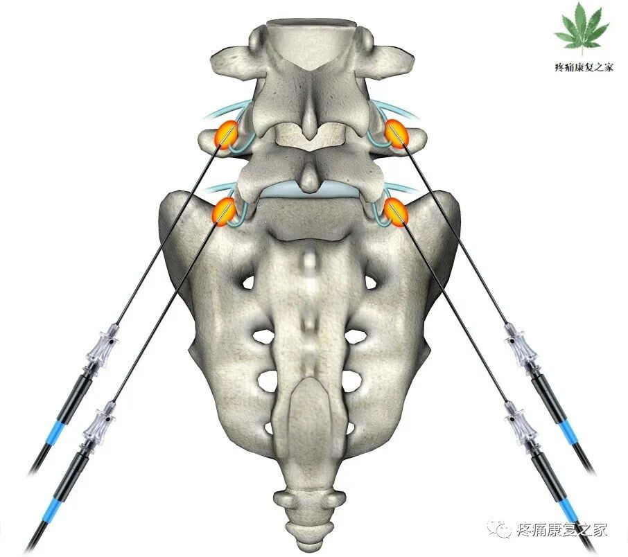 射频什么科【图文版】射频治疗技术疼痛科专家共识_https://www.jmylbn.com_新闻资讯_第18张