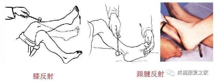 三头肌反 射、跟腱反射、膝反射可能亢进、减弱或者消失，检查时要仔细。