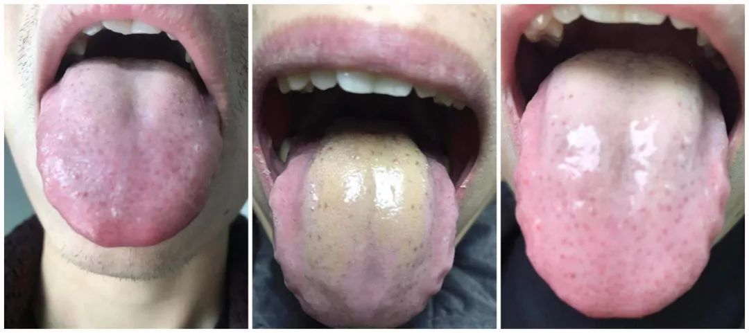 小舌头大健康④舌诊杂谈