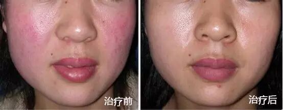 "面色红润"增美色,"面部潮红"非美人