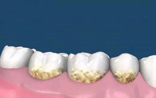 牙菌斑,牙结石反复在牙齿上堆积了一层又一层,时间久后牙齿越来越黄