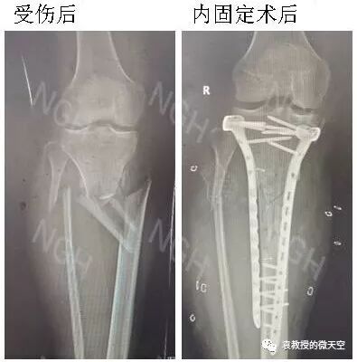 小腿创面修复 1 中上段创面 袁教授的微天空 微信公众号文章阅读 Wemp