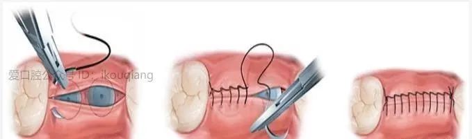 种植手术中部分缝合归纳