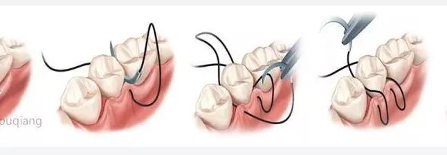 种植手术中部分缝合归纳