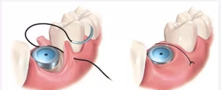 种植手术中部分缝合归纳