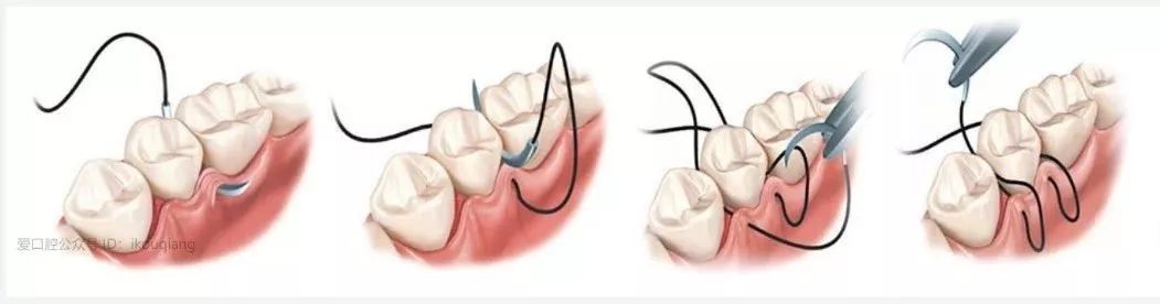 种植手术中部分缝合归纳