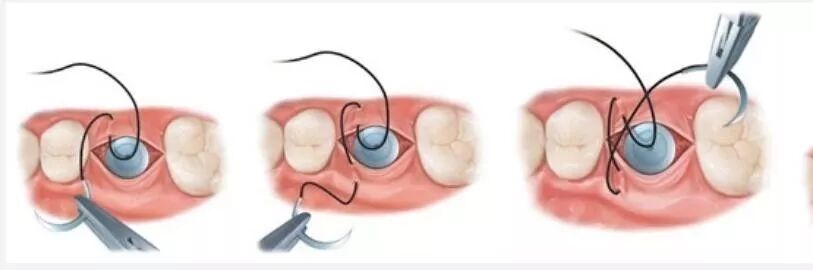 种植手术中部分缝合归纳