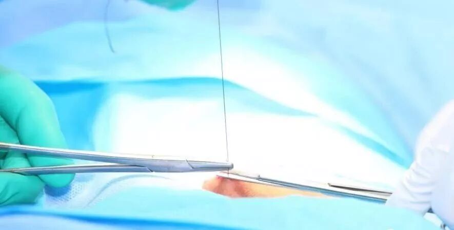 种植手术中部分缝合归纳