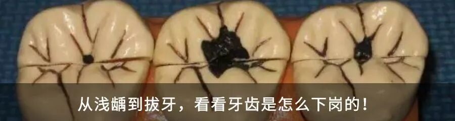 为什么牙医不用开口器【牙医必备】带你认识一下口腔医师的“十八般武器”_https://www.jmylbn.com_新闻资讯_第21张