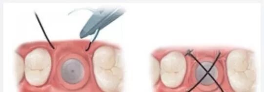 种植手术中部分缝合归纳