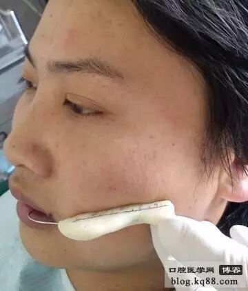 x光机为什么实用牙科X光拍摄技术与心得_https://www.jmylbn.com_新闻资讯_第16张