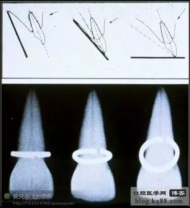 x光机为什么实用牙科X光拍摄技术与心得_https://www.jmylbn.com_新闻资讯_第23张