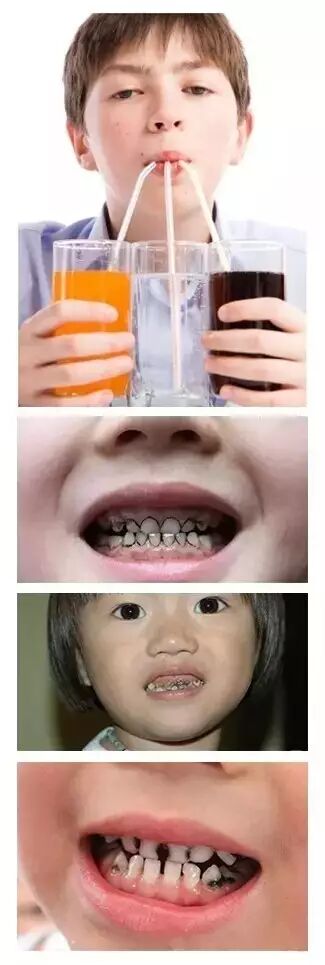碳酸饮料是如何慢慢地腐蚀你的牙齿