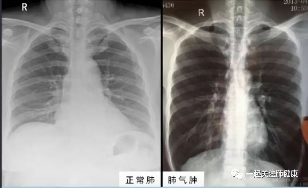 解析肺气肿和肺心病 附治疗方案 肺部健康咨询 微信公众号文章阅读 Wemp