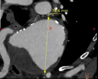 治疗车怎么推【弓部重建直通车】梅州市人民医院心内科团队运用Castor®分支型支架联合预开窗技术治疗主动脉弓动脉瘤合并迷走右锁骨下动_https://www.jmylbn.com_新闻资讯_第4张