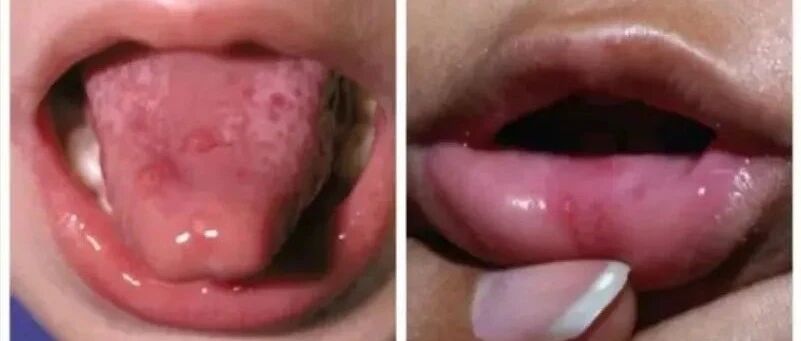 幼儿园温馨提醒：手足口、疱疹性咽颊炎多地爆发，这些防治攻略必须了解掌握！