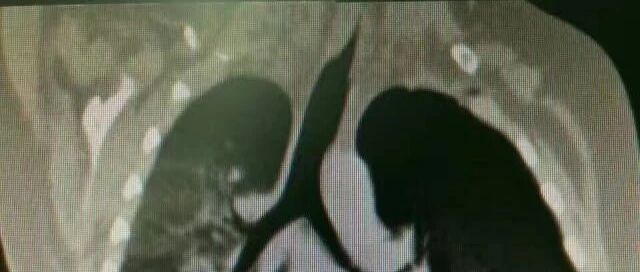 一件衣服害孩子反复肺炎3个月，幼儿园提醒：家长们注意，这些衣服少买!