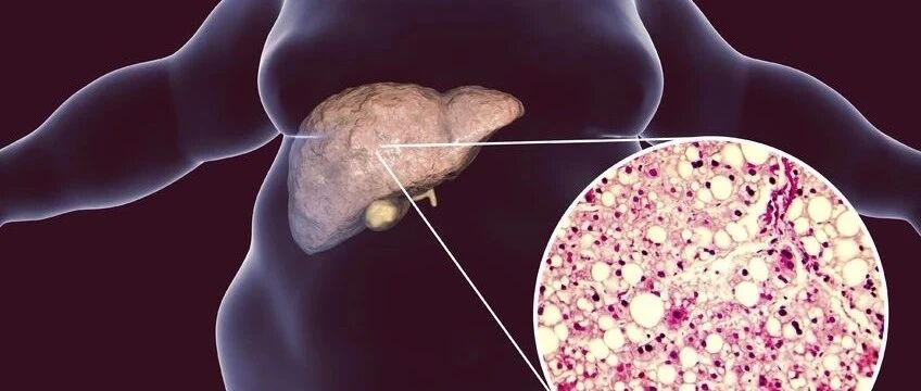 51年队列研究数据：轻度脂肪肝增加7成死亡风险！