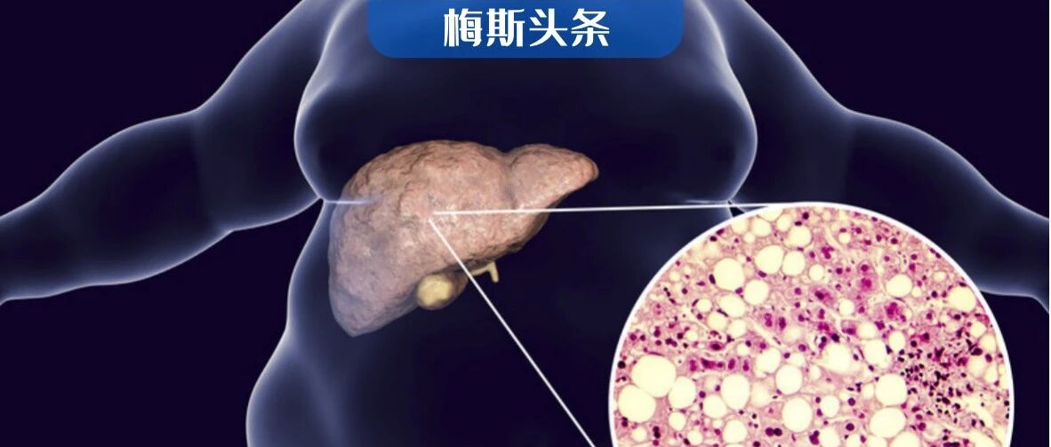 51年队列研究：轻度脂肪肝增加7成死亡风险！