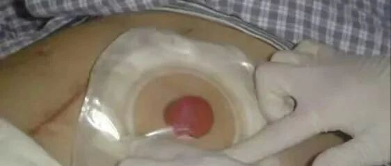 在中国，有100万人因肠癌失去肛门...医生也不能幸免