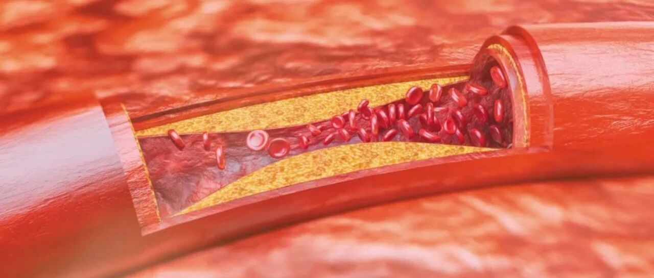 减少老年痴呆风险 ，心血管健康是关键