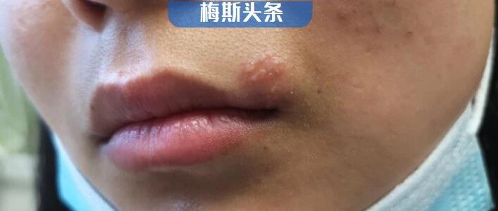 90%的人群被它折磨却无法根治！Nature最新研究为治愈带来希望