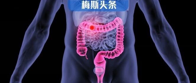 柳叶刀：这种早发癌症近10年发病率翻倍，一旦发现多为晚期