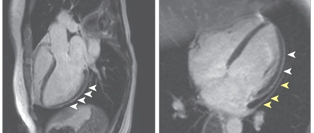 COVID-19康复患者的心血管磁共振成像结果