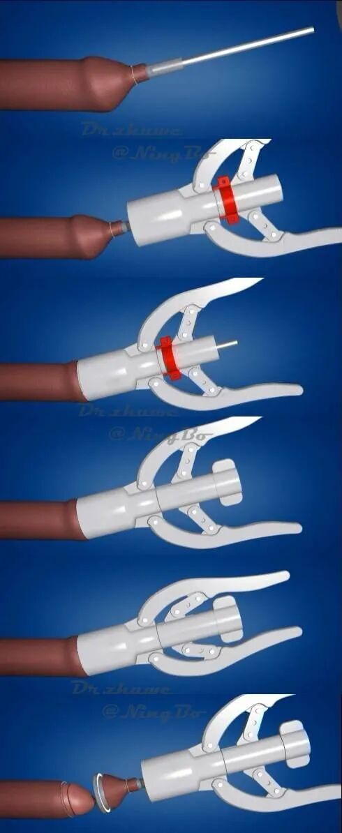 包皮吻合器是什么一次性包皮环切吻合器的临床应用_https://www.jmylbn.com_新闻资讯_第7张