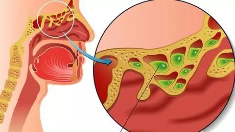 惊了！！！鼻息肉竟会引起一系列的严重的病症？