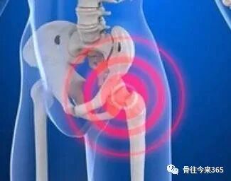 髋关节滑膜炎：不把早期病变拖成关节破坏!