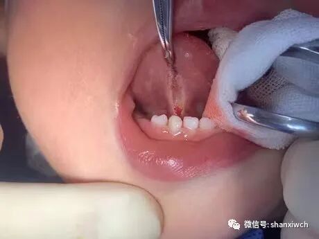 半导体软激光有什么用【前沿】半导体激光——引领儿童口腔舒适化治疗_https://www.jmylbn.com_新闻资讯_第5张