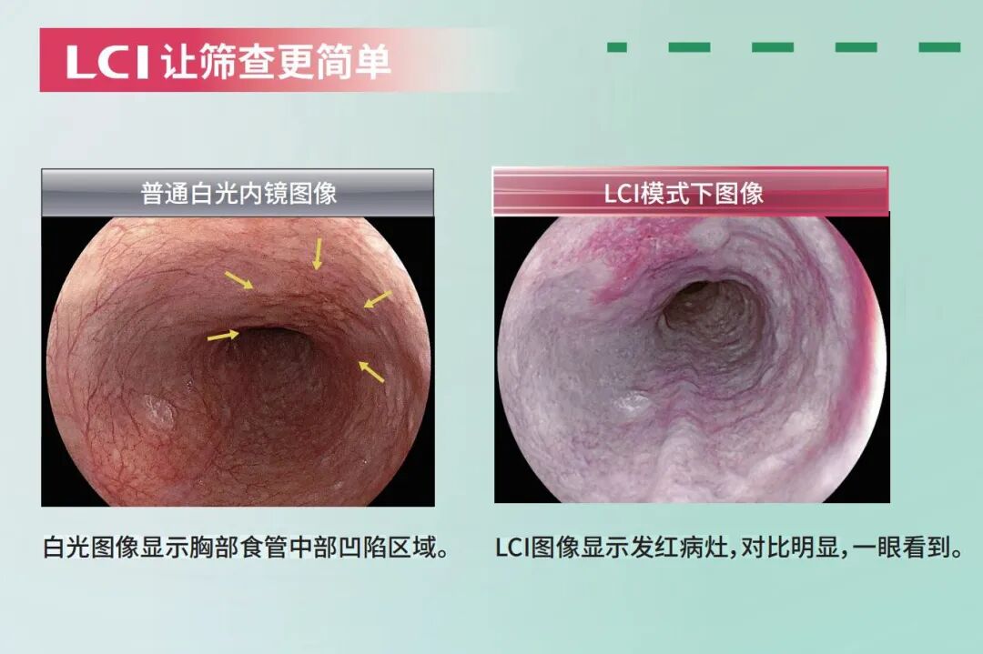 富士胃镜英文怎么写超赞！！乐平市人民医院消化内镜中心引进新一代富士 ELUXEO 7000 高清蓝光电子胃肠镜，引领内镜诊疗新“镜”界_https://www.jmylbn.com_新闻资讯_第11张