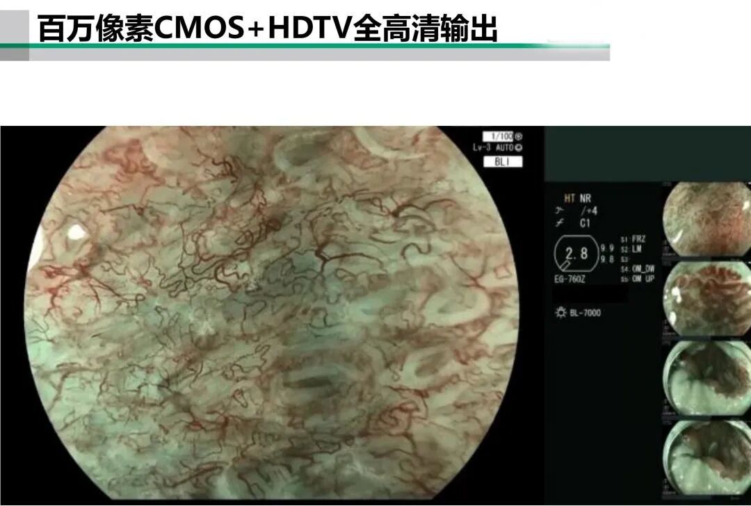 富士胃镜英文怎么写超赞！！乐平市人民医院消化内镜中心引进新一代富士 ELUXEO 7000 高清蓝光电子胃肠镜，引领内镜诊疗新“镜”界_https://www.jmylbn.com_新闻资讯_第8张