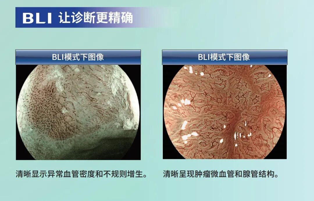 富士胃镜英文怎么写超赞！！乐平市人民医院消化内镜中心引进新一代富士 ELUXEO 7000 高清蓝光电子胃肠镜，引领内镜诊疗新“镜”界_https://www.jmylbn.com_新闻资讯_第12张