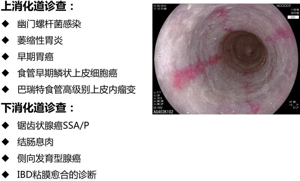富士胃镜英文怎么写超赞！！乐平市人民医院消化内镜中心引进新一代富士 ELUXEO 7000 高清蓝光电子胃肠镜，引领内镜诊疗新“镜”界_https://www.jmylbn.com_新闻资讯_第13张