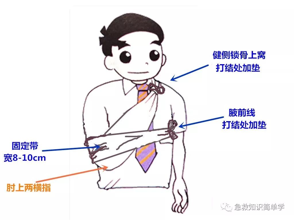 骨折 固定 鎖骨