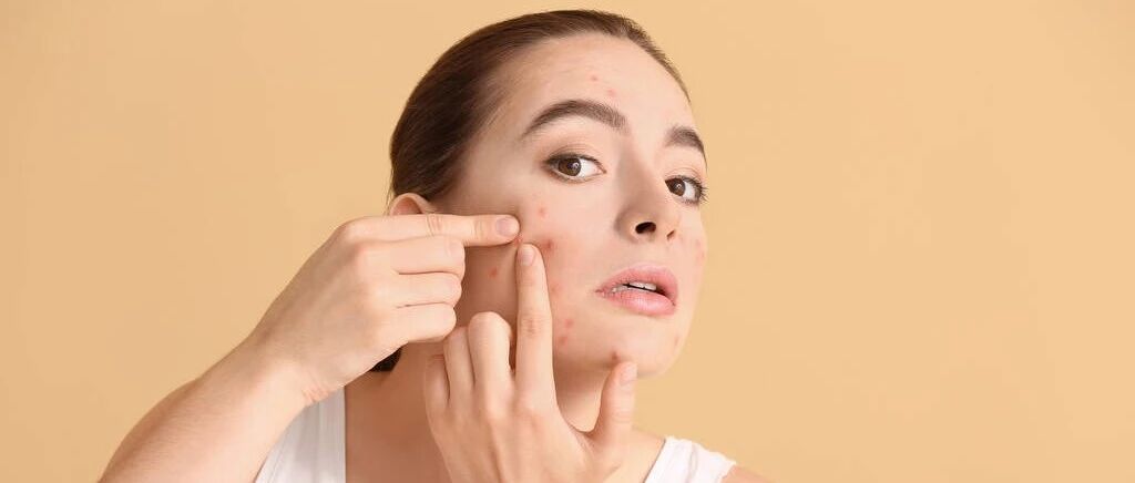 好消息！ “青春痘”也要有疫苗了