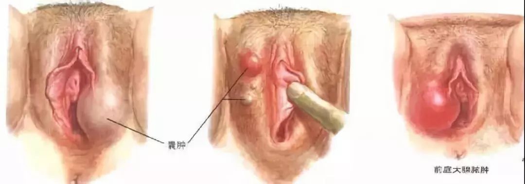 说说前庭大腺囊肿那些事儿 弥渡县中医院 微信公众号文章阅读 Wemp