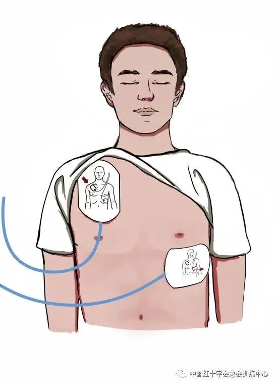 aed电极贴怎么贴AED除颤仪怎么用？看这篇就够了_https://www.jmylbn.com_新闻资讯_第4张