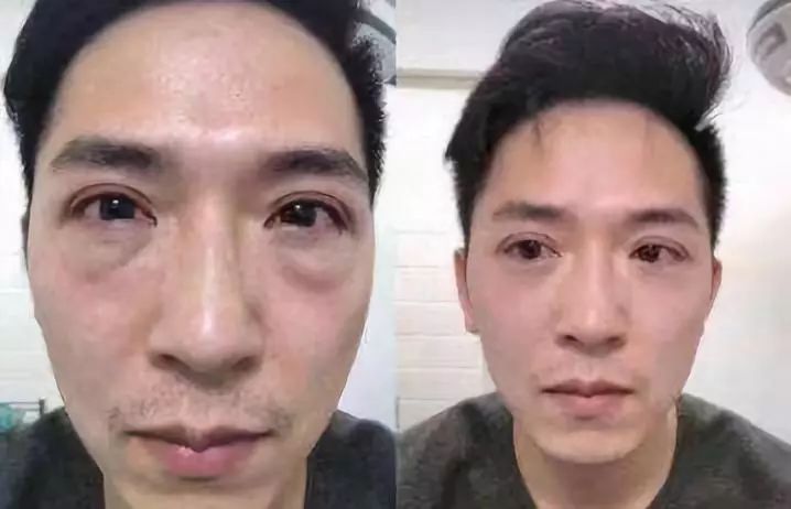 眼袋有多大，就有多显老！教你1方法，让眼袋悄悄消失！!!