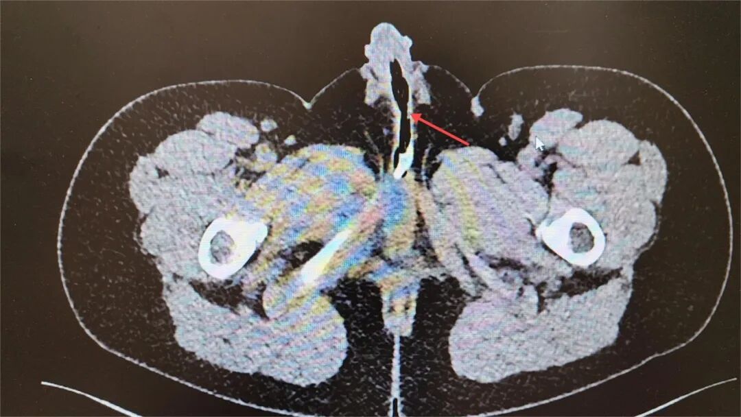 痛！十一岁男孩将66厘米塑料管完全插入尿道！