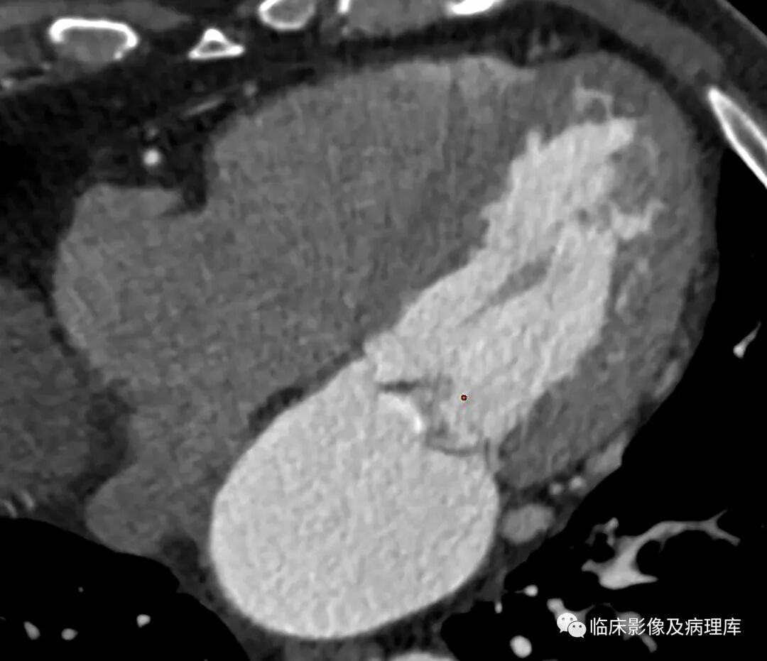 ero为什么不显示二尖瓣关闭不全CT表现_https://www.jmylbn.com_新闻资讯_第4张