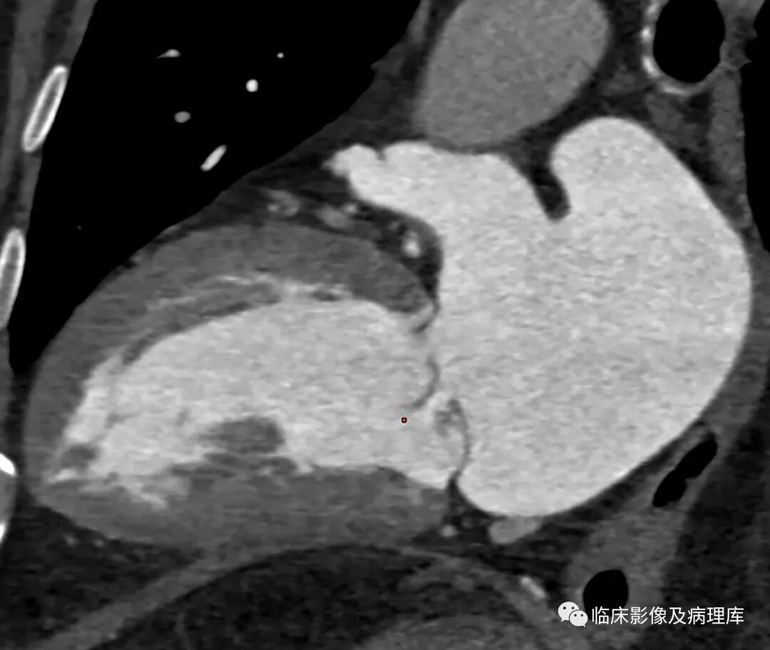 ero为什么不显示二尖瓣关闭不全CT表现_https://www.jmylbn.com_新闻资讯_第5张