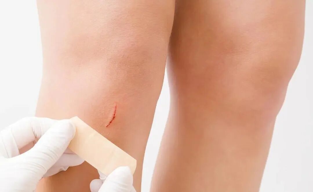 德维可液体敷料怎么用液体敷料应用于皮肤慢性溃疡的疗效观察及护理_https://www.jmylbn.com_新闻资讯_第2张