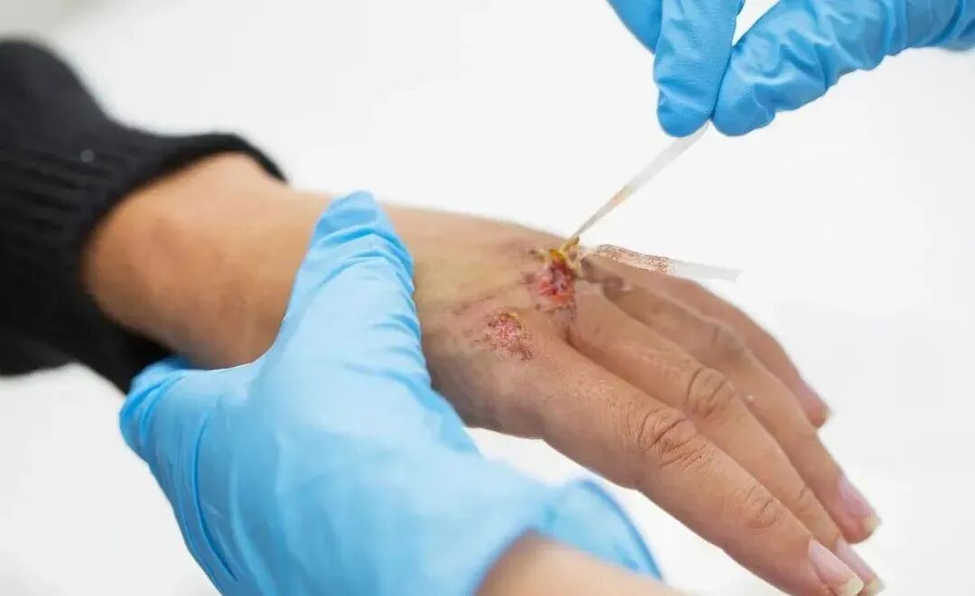 德维可液体敷料怎么用液体敷料应用于皮肤慢性溃疡的疗效观察及护理_https://www.jmylbn.com_新闻资讯_第4张