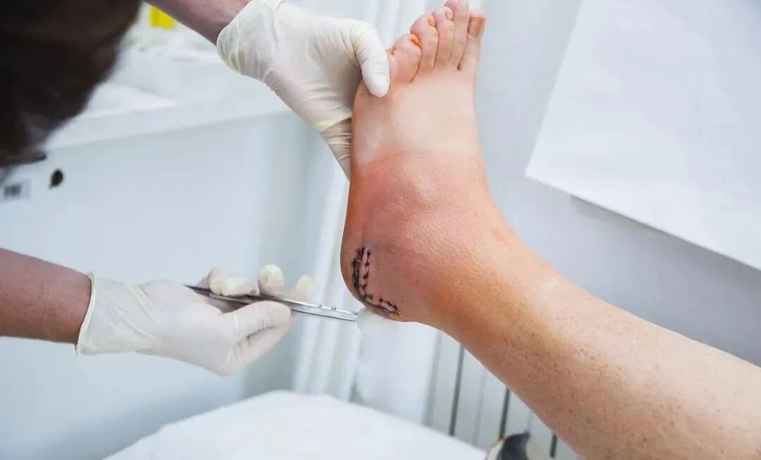 抗菌清创敷料怎么使用糖尿病足溃疡创面清创方法研究进展_https://www.jmylbn.com_新闻资讯_第7张