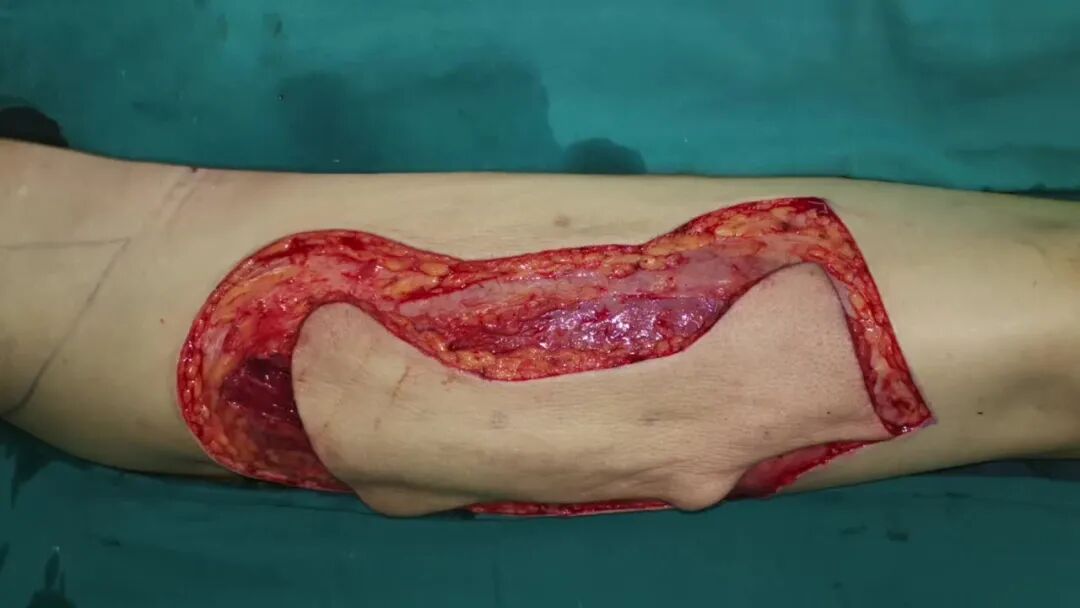 抗菌清创敷料怎么使用伤口知识：影响伤口愈合的因素及伤口床准备_https://www.jmylbn.com_新闻资讯_第4张