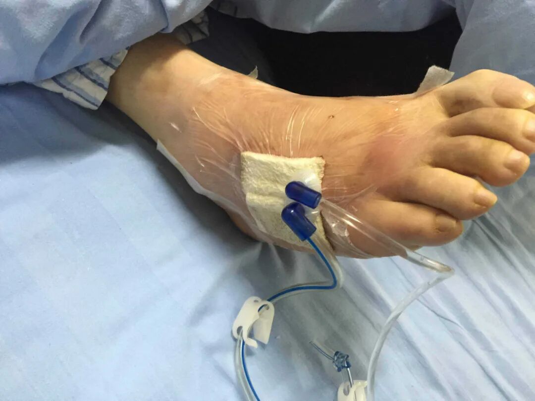 抗菌清创敷料怎么使用糖尿病足溃疡创面清创方法研究进展_https://www.jmylbn.com_新闻资讯_第4张